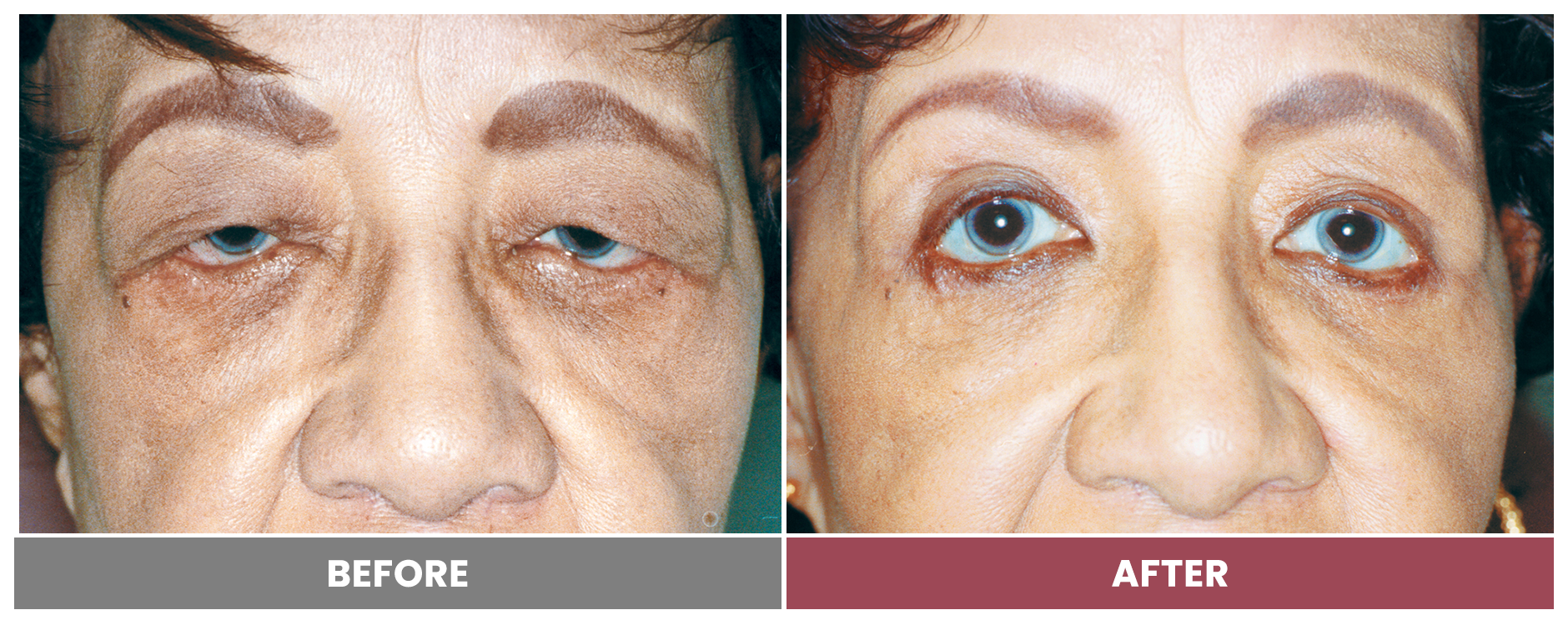 Upper Blepharoplasty - Case 77